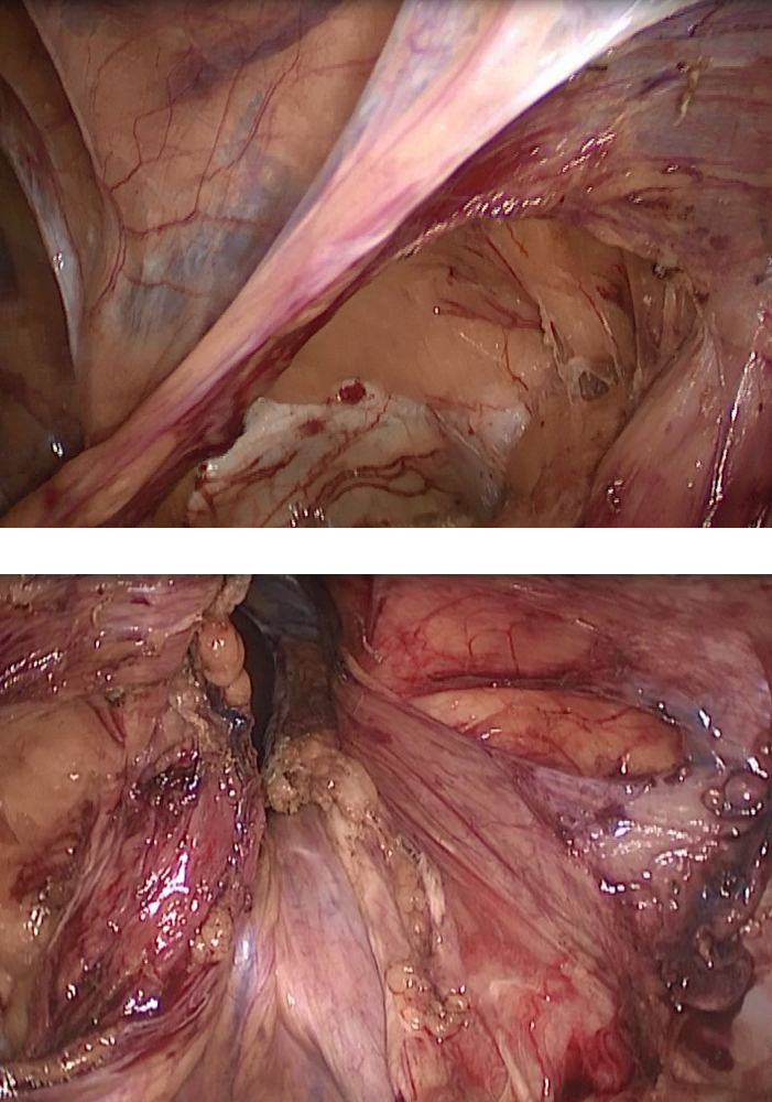 巨大复发性腹股沟疝的治疗        科室:         普外科